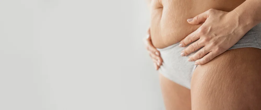 5 dicas simples para evitar estrias na gravidez